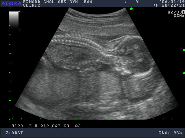 17week