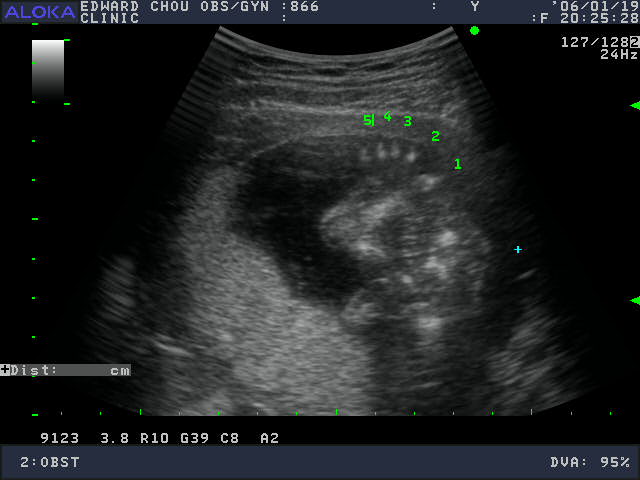 17week—五根手指頭